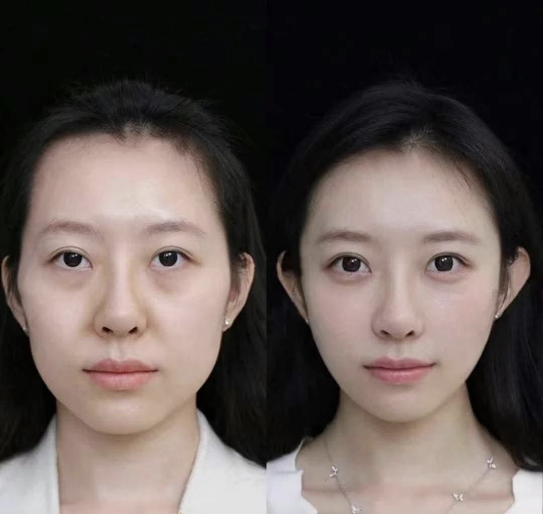 Skin Lifting & Radiance before