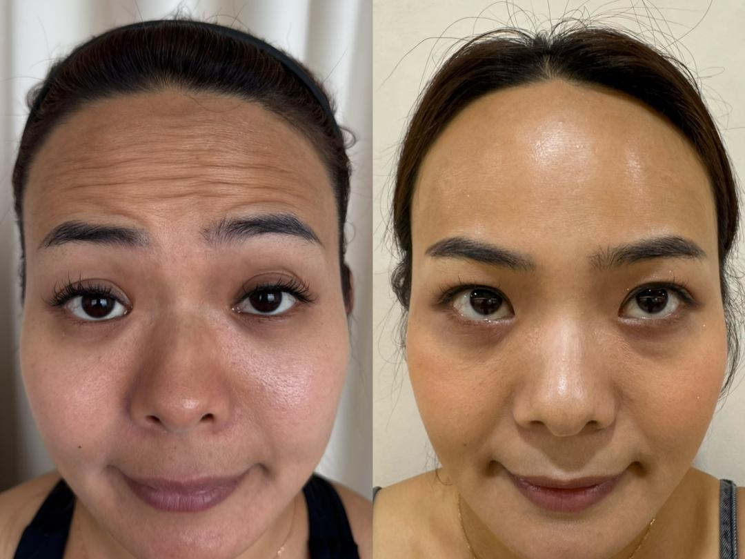 Forehead Lines & Texture before