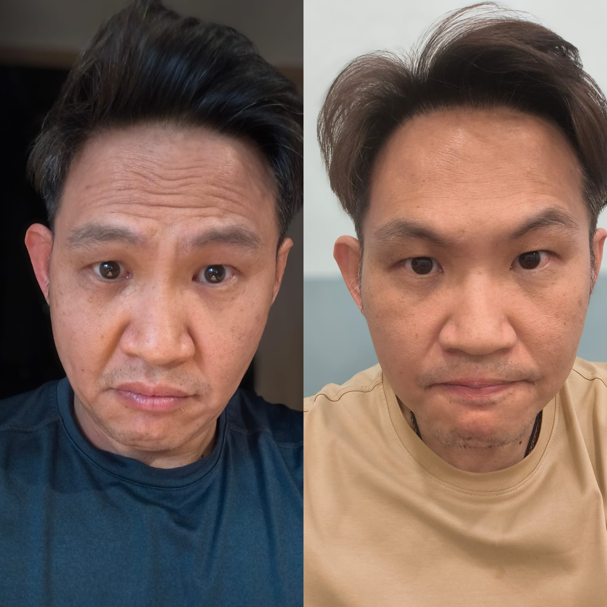 Facial Contour & Lift before